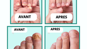 MycoLight™ Fini les mycoses, bonjour les ongles sains