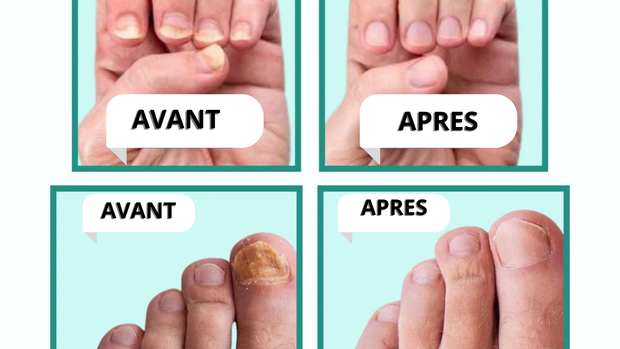 MycoLight™ Fini les mycoses, bonjour les ongles sains
